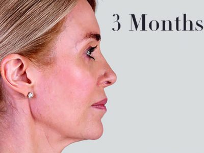 Ultherapy Facelift Review