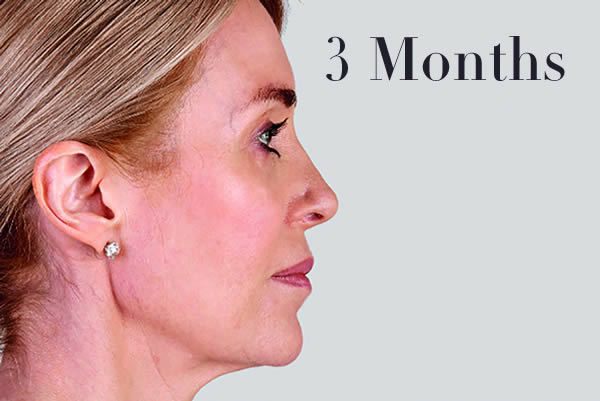 Ultherapy Facelift Review