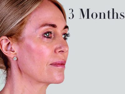 Ultherapy Facelift Review