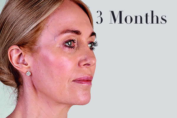 Ultherapy Facelift Review