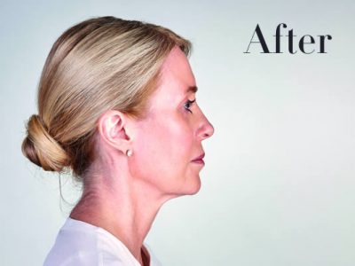 Ultherapy Facelift Review