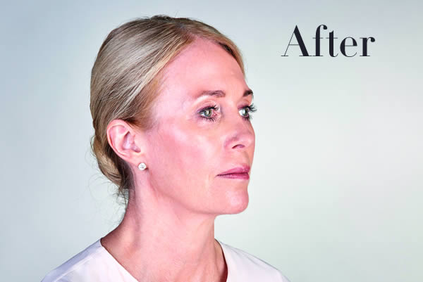 Ultherapy Facelift Review