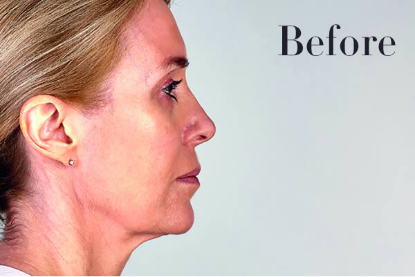 Ultherapy Facelift Review