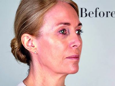 Ultherapy Facelift Review