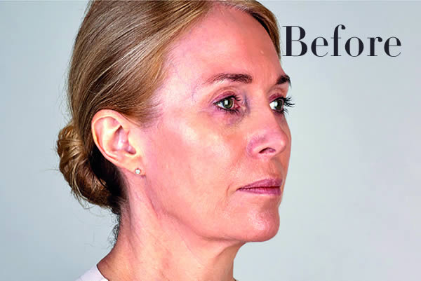 Ultherapy Facelift Review
