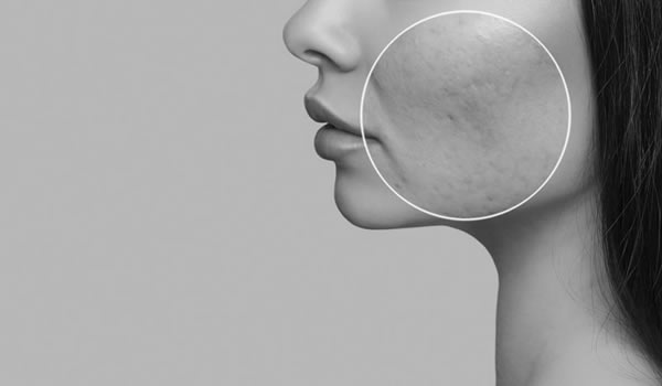 CO2 GAAS Laser Skin Resurfacing