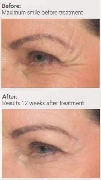 Wrinkle Injections before and after