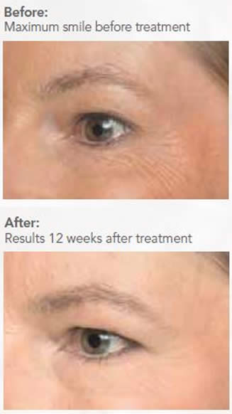 Wrinkle Injections before and after