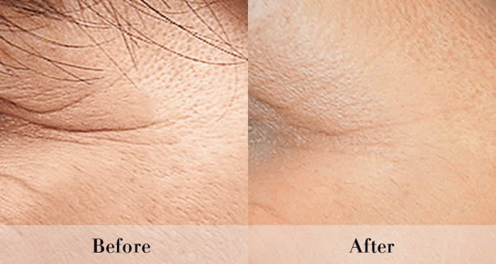 Wrinkle Injections before and after