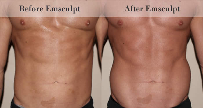 Stomach & Ab Toning