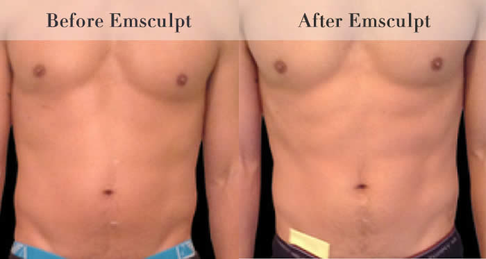 Stomach & Ab Toning