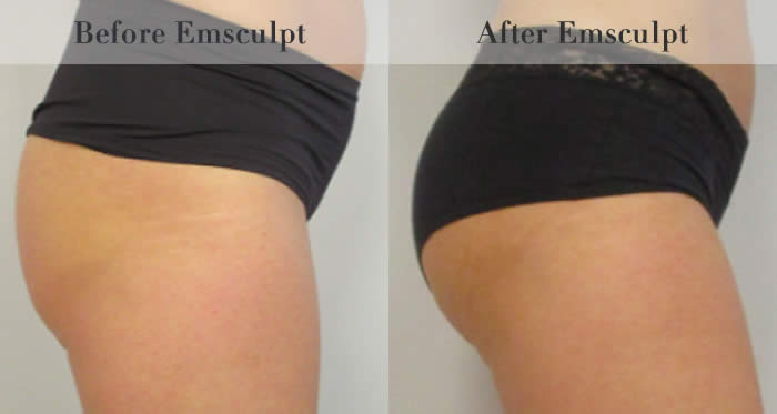 Bum Lifting
