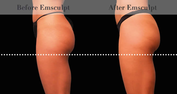 Bum Lifting