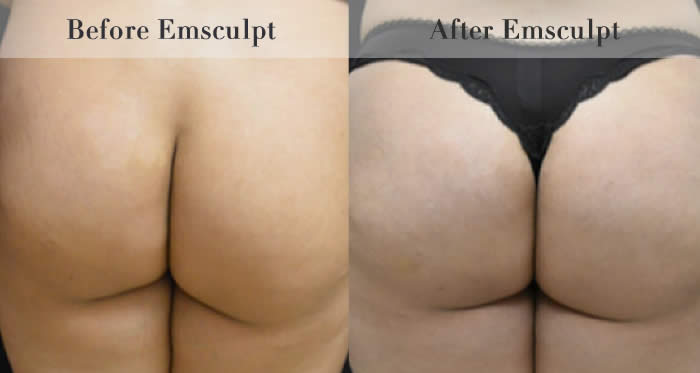 Bum Lifting
