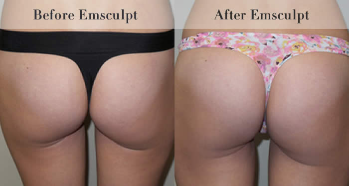 Bum Lifting