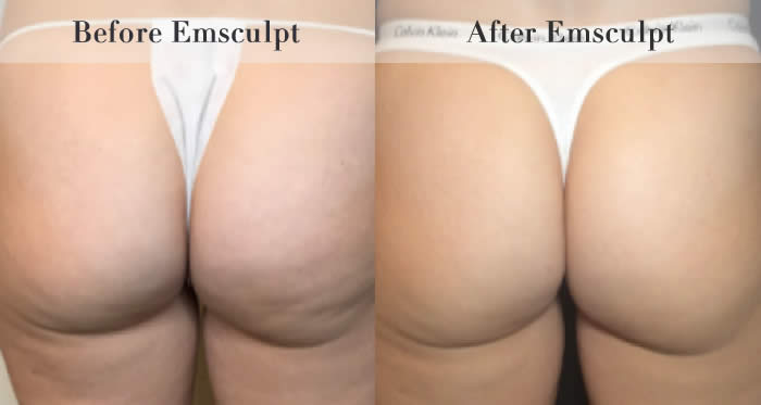 Bum Lifting