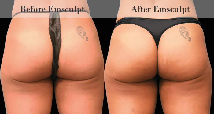 Bum Lifting