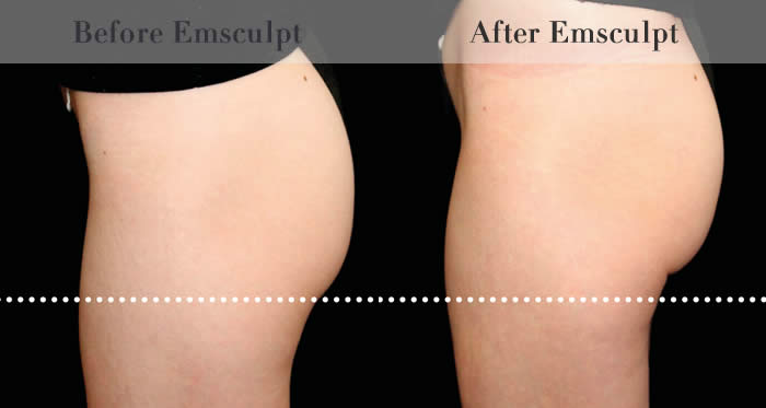 Bum Lifting