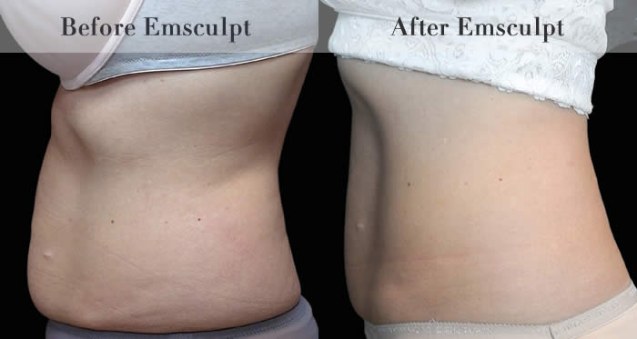 Love Handles & Belly Fat Reduction