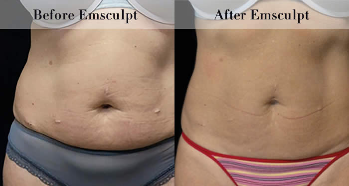 Love Handles & Belly Fat Reduction