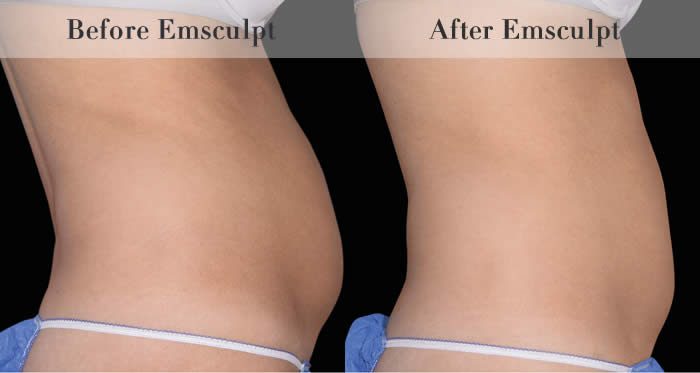 Love Handles & Belly Fat Reduction