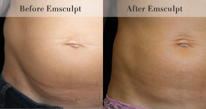 Love Handles & Belly Fat Reduction