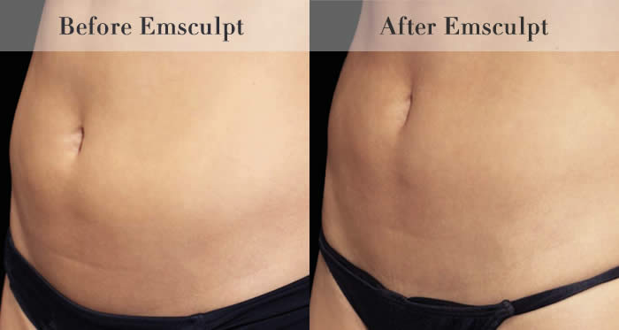 Love Handles & Belly Fat Reduction