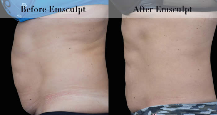 Love Handles & Belly Fat Reduction