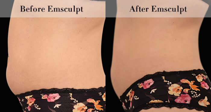 Love Handles & Belly Fat Reduction