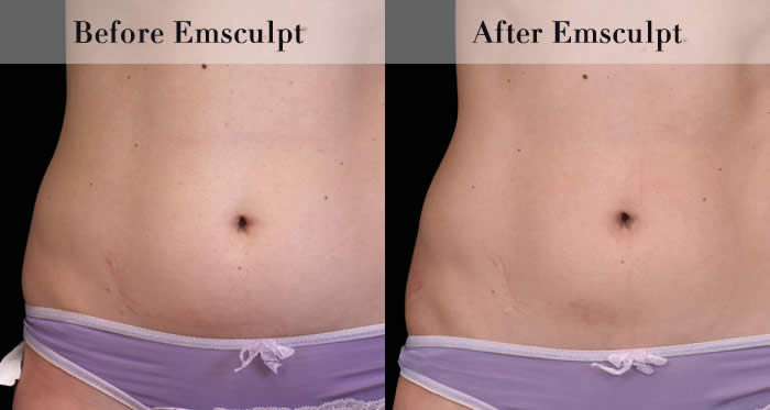 Love Handles & Belly Fat Reduction