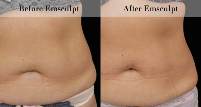 Love Handles & Belly Fat Reduction