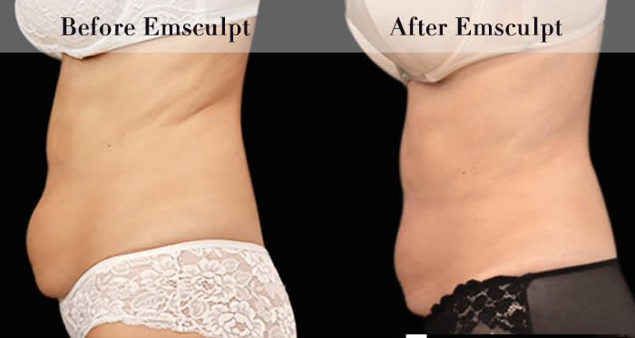 Love Handles & Belly Fat Reduction