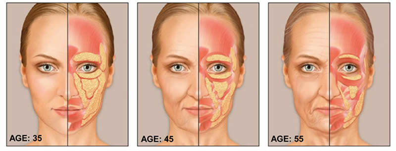 Dermal Fillers
