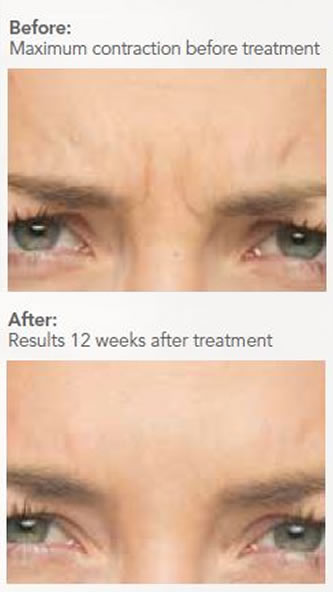 wrinkle Injections before and after