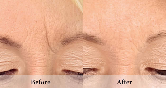 Wrinkle Injections before and after