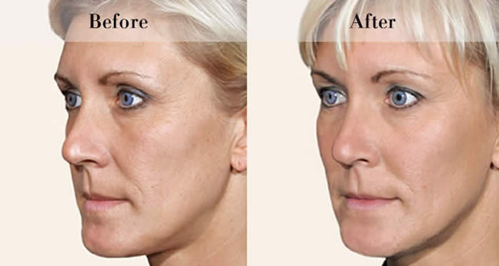 Full Face Dermal Fillers Before & After