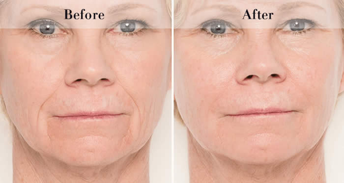 Jawline Definition Before & After
