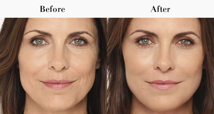 Full Face Dermal Fillers Before & After