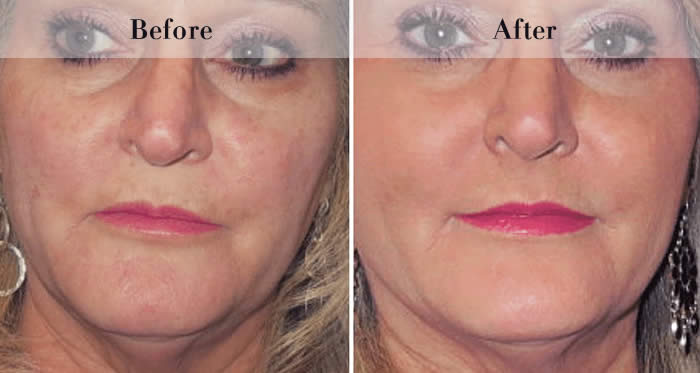 Full Face Dermal Fillers Before & After