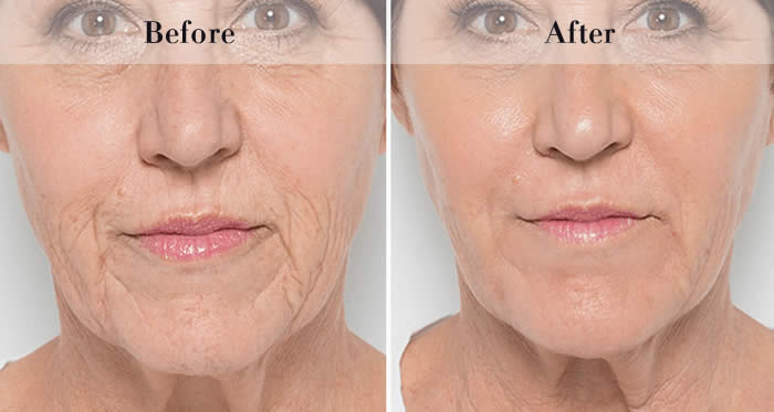 Jawline Definition Before & After