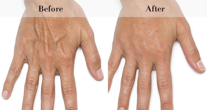 Dermal Fillers Before & After