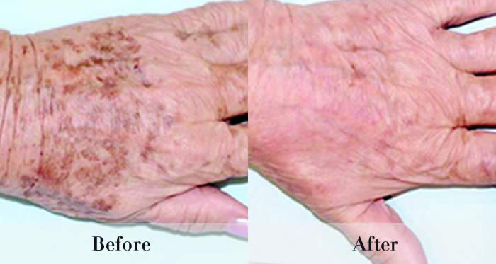 Photo Rejuvenation Before & After