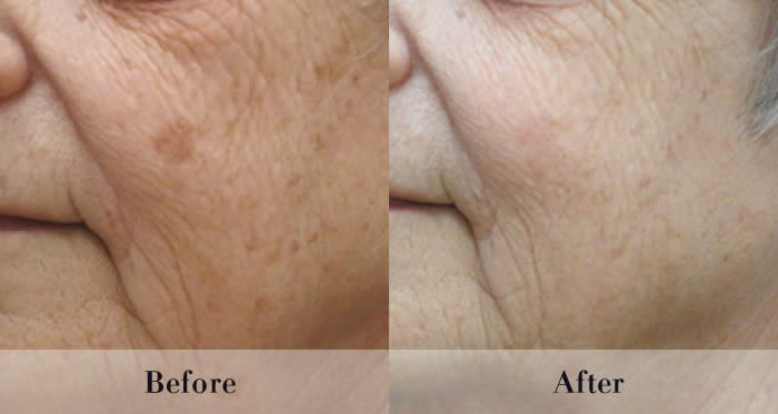 Photo Rejuvenation Before & After