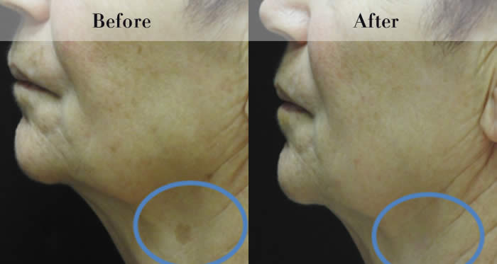 Photo Rejuvenation Before & After