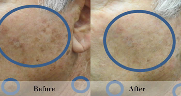 Photo Rejuvenation Before & After