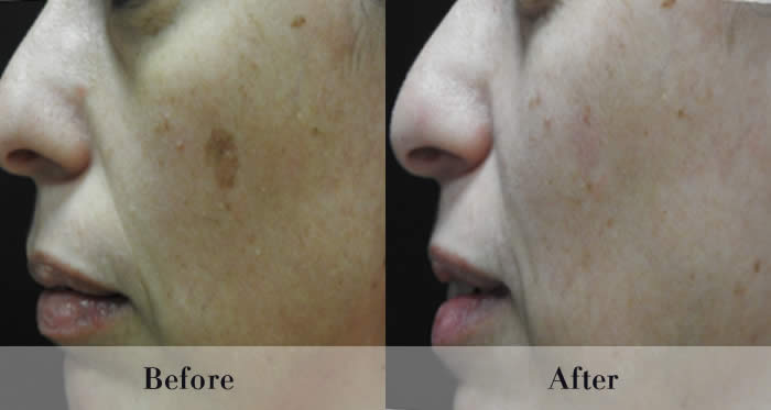 Photo Rejuvenation Before & After