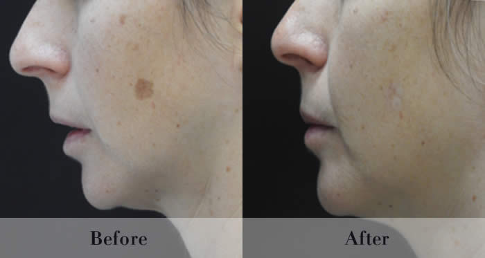 Photo Rejuvenation Before & After