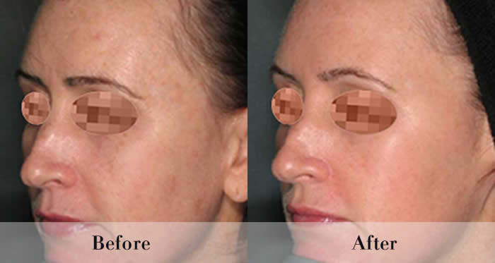 Photo Rejuvenation Before & After