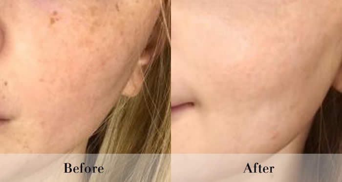 Photo Rejuvenation Before & After
