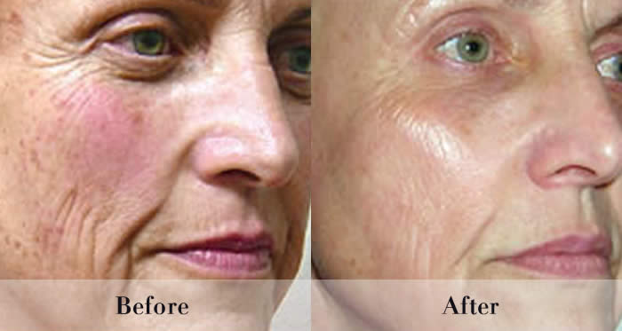 Photo Rejuvenation Before & After